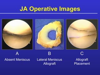 JA Operative Images A B C Absent Meniscus Lateral Meniscus Allograft Allograft Placement 