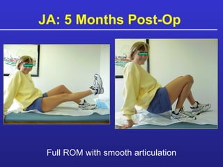 JA: 5 Months Post-Op  Full ROM with smooth articulation 