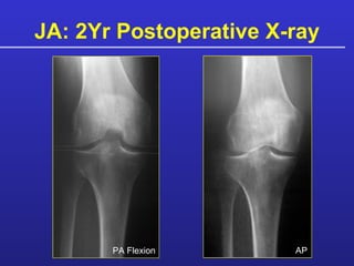 JA: 2Yr Postoperative X-ray PA Flexion AP 
