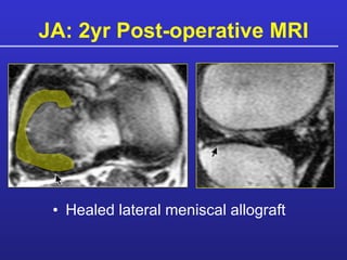 JA: 2yr Post-operative MRI Healed lateral meniscal allograft 