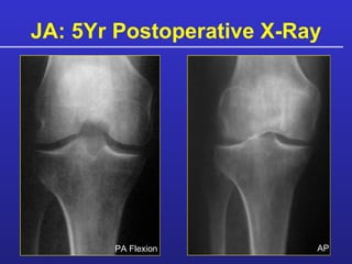 JA: 5Yr Postoperative X-Ray PA Flexion AP 