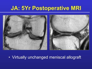 JA: 5Yr Postoperative MRI Virtually unchanged meniscal allograft 