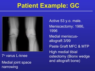 Patient Example: GC 7 o  varus L-knee Medial joint space narrowing Active 53 y.o. male. Meniscectomy: 1986, 1996 Medial meniscus-allograft 3/99  Paste Graft MFC & MTP High medial tibial osteotomy (Bionx wedge and allograft bone) 