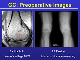 GC: Preoperative Images Sagittal MRI Loss of cartilage MFC PA Flexion Medial joint space narrowing 