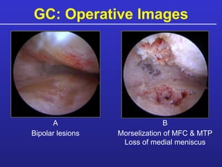 GC: Operative Images A B Bipolar lesions Morselization of MFC & MTP Loss of medial meniscus 