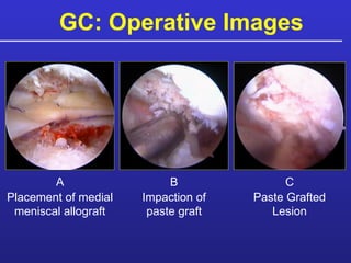 GC: Operative Images A B C Placement of medial meniscal allograft Impaction of paste graft Paste Grafted Lesion 