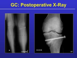 GC: Postoperative X-Ray Long-leg AP 