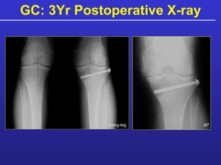 GC: 3Yr Postoperative X-ray AP Long-leg 
