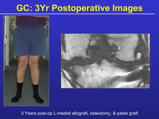 GC: 3Yr Postoperative Images 3 Years post-op L-medial allograft, osteotomy, & paste graft 