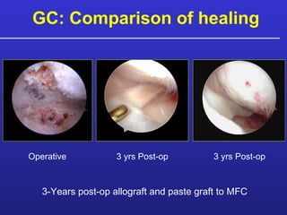 GC: Comparison of healing 3-Years post-op allograft and paste graft to MFC Operative 3 yrs Post-op 3 yrs Post-op 