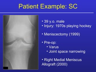 Patient Example: SC 39 y.o. male Injury: 1970s playing hockey  Meniscectomy (1999) Pre-op:  Varus  Joint space narrowing Right Medial Meniscus  Allograft (2000) 
