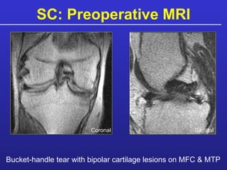 SC: Preoperative MRI Bucket-handle tear with bipolar cartilage lesions on MFC & MTP Coronal Sagittal 