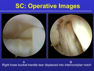 SC: Operative Images Right knee bucket-handle tear displaced into intercondylar notch A B 