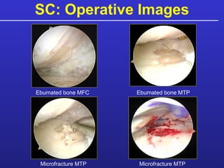 SC: Operative Images Eburnated bone MFC Eburnated bone MTP Microfracture MTP Microfracture MTP 