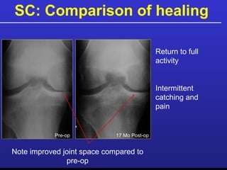 SC: Comparison of healing   Return to full activity Intermittent catching and pain 17 Mo Post-op Pre-op Note improved joint space compared to pre-op 