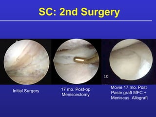 SC: 2nd Surgery Movie 17 mo. Post  Paste graft MFC +  Meniscus  Allograft Initial Surgery 17 mo. Post-op Meniscectomy 