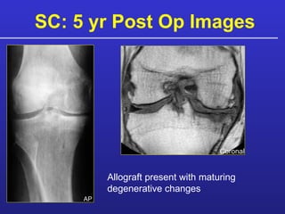 SC: 5 yr Post Op Images AP Allograft present with maturing degenerative changes Coronal 