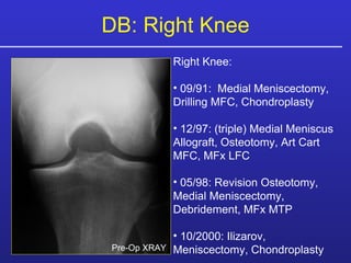 DB: Right Knee Right Knee:  09/91:  Medial Meniscectomy, Drilling MFC, Chondroplasty 12/97: (triple) Medial Meniscus Allograft, Osteotomy, Art Cart MFC, MFx LFC 05/98: Revision Osteotomy, Medial Meniscectomy, Debridement, MFx MTP 10/2000: Ilizarov, Meniscectomy, Chondroplasty Pre-Op XRAY 
