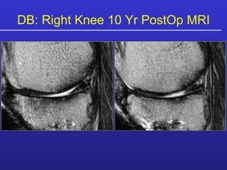DB: Right Knee 10 Yr PostOp MRI 