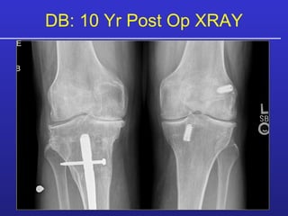 DB: 10 Yr Post Op XRAY 
