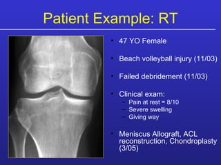 47 YO Female Beach volleyball injury (11/03) Failed debridement (11/03) Clinical exam: Pain at rest = 8/10 Severe swelling  Giving way Meniscus Allograft, ACL reconstruction, Chondroplasty (3/05) Patient Example: RT 