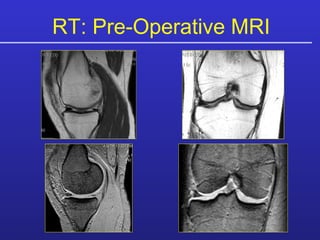 RT: Pre-Operative MRI 