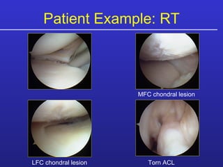 Torn medial meniscus MFC chondral lesion LFC chondral lesion Torn ACL Patient Example: RT 