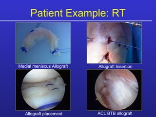 Medial meniscus Allograft Allograft Insertion Allograft placement ACL BTB allograft Patient Example: RT 