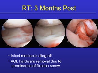 Intact meniscus allograft ACL hardware removal due to   prominence of fixation screw RT: 3 Months Post 