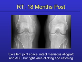 Excellent joint space, intact meniscus allograft and ACL, but right knee clicking and catching RT: 18 Months Post 