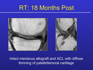 Intact meniscus allograft and ACL with diffuse thinning of patellofemoral cartilage RT: 18 Months Post 