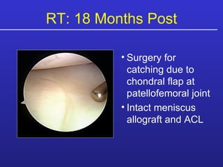 Surgery for catching due to chondral flap at patellofemoral joint Intact meniscus allograft and ACL RT: 18 Months Post 