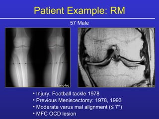 Patient Example: RM 57 Male Long-leg MRI Injury: Football tackle 1978  Previous Meniscectomy: 1978, 1993 Moderate varus mal alignment ( ≤ 7°) MFC OCD lesion 