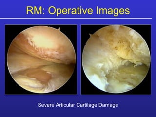 RM: Operative Images Severe Articular Cartilage Damage 