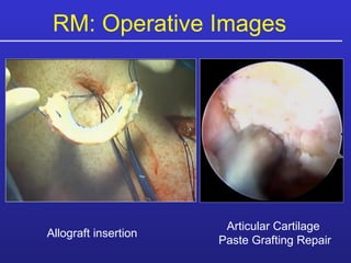 RM: Operative Images  Allograft insertion Articular Cartilage  Paste Grafting Repair 