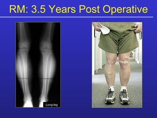 RM: 3.5 Years Post Operative Long-leg 