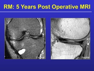 RM: 5 Years Post Operative MRI Sagittal Coronal 