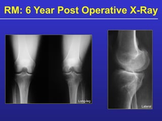 RM: 6 Year Post Operative X-Ray Long-leg Lateral 