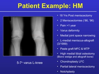 Patient Example: HM 5-7 o  varus L-knee 18 Yrs Post meniscectomy  2 Meniscectomies (‘86, ’96) Pain >1 year Varus deformity Medial joint space narrowing L-medial meniscus-allograft (3/1999)  Paste graft MFC & MTP High medial tibial osteotomy  (Bionx wedge and allograft bone) Chondroplasty LFC Partial lateral meniscectomy Notchplasty 