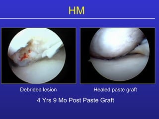 HM  4 Yrs 9 Mo Post Paste Graft Debrided lesion Healed paste graft 