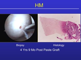 HM   4 Yrs 9 Mo Post Paste Graft Biopsy Histology 
