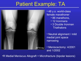 Patient Example: TA 48 y.o. world-class female marathoner 86 marathons,  12 Ironmans 3 Double Ironman   Triathalons Neutral alignment / mild medial joint space narrowing Meniscectomy: 4/2001 and 1/2002 AP X-ray R Medial Meniscus Allograft + Microfracture (bipolar lesions) 