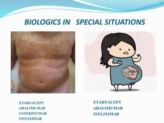 BIOLOGICS IN SPECIAL SITUATIONS
ETARNACEPT
ADALIMUMAB
USTEKINUMAB
INFLIXIMAB
ETARNACEPT
ADALIMUMAB
INFLIXIMAB
 
