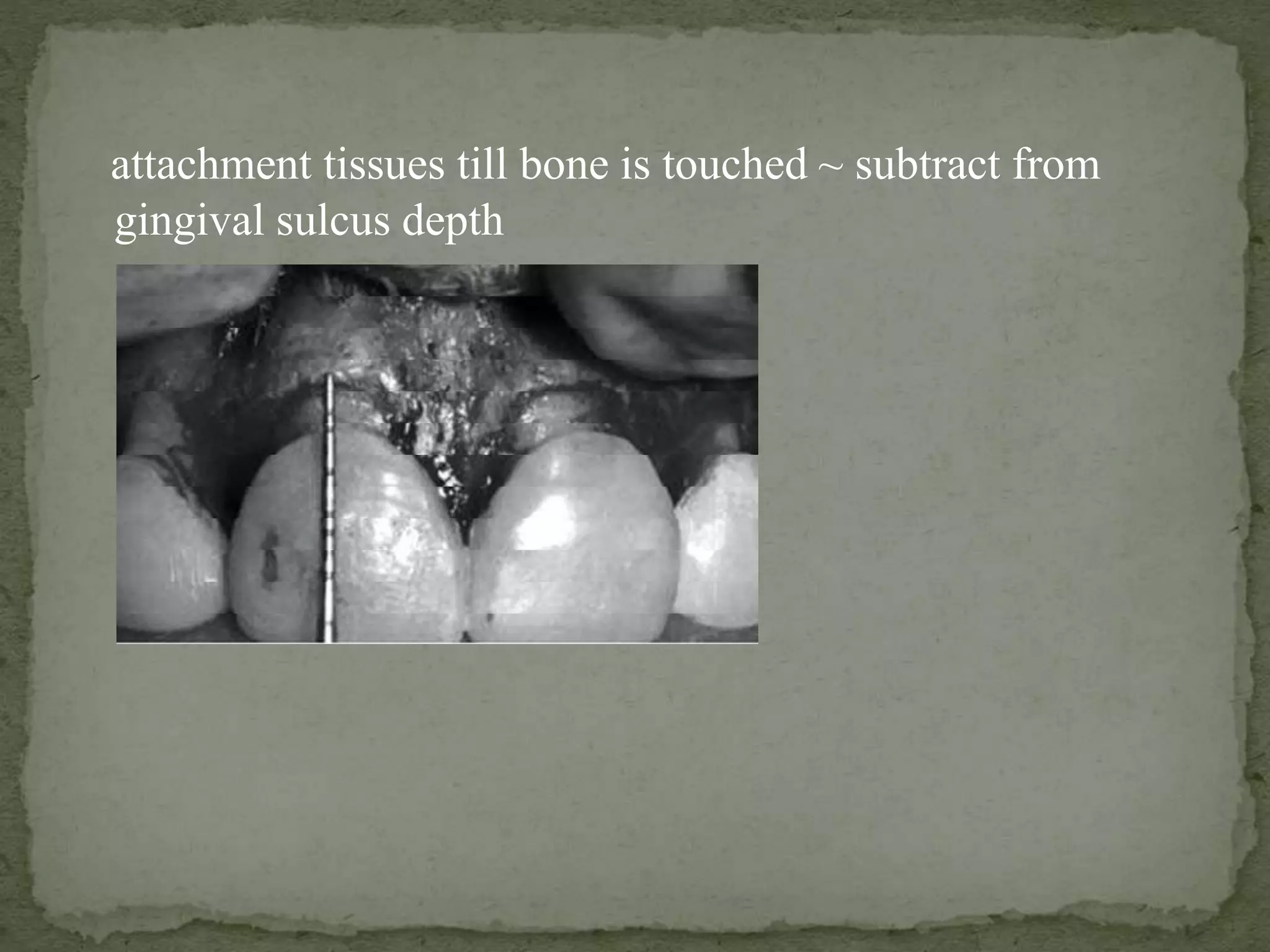 attachment tissues till bone is touched ~ subtract from
gingival sulcus depth
 