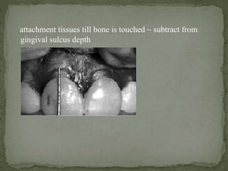 attachment tissues till bone is touched ~ subtract from
gingival sulcus depth
 
