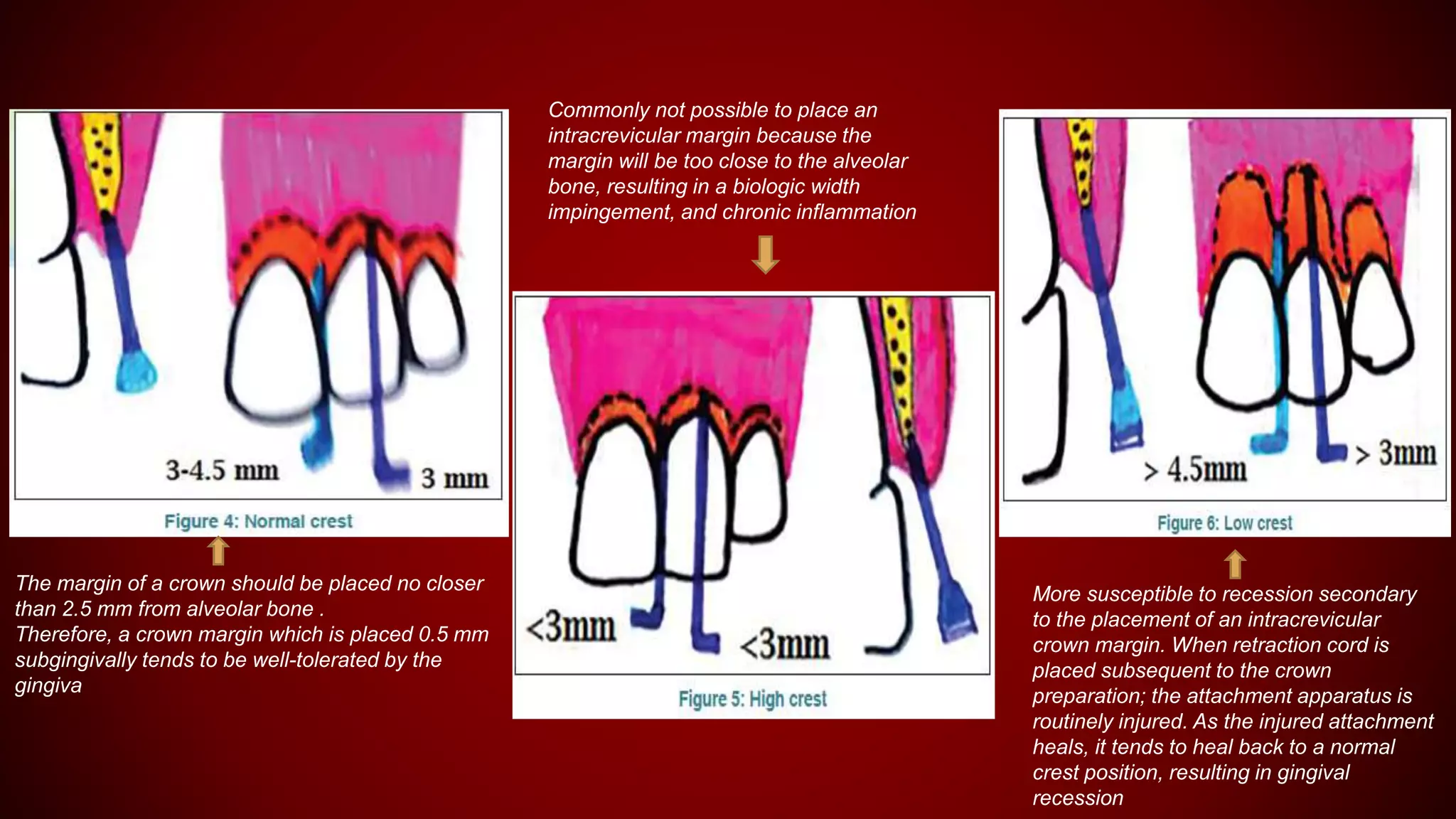 The margin of a crown should be placed no closer
than 2.5 mm from alveolar bone .
Therefore, a crown margin which is placed 0.5 mm
subgingivally tends to be well-tolerated by the
gingiva
Commonly not possible to place an
intracrevicular margin because the
margin will be too close to the alveolar
bone, resulting in a biologic width
impingement, and chronic inflammation
More susceptible to recession secondary
to the placement of an intracrevicular
crown margin. When retraction cord is
placed subsequent to the crown
preparation; the attachment apparatus is
routinely injured. As the injured attachment
heals, it tends to heal back to a normal
crest position, resulting in gingival
recession
 