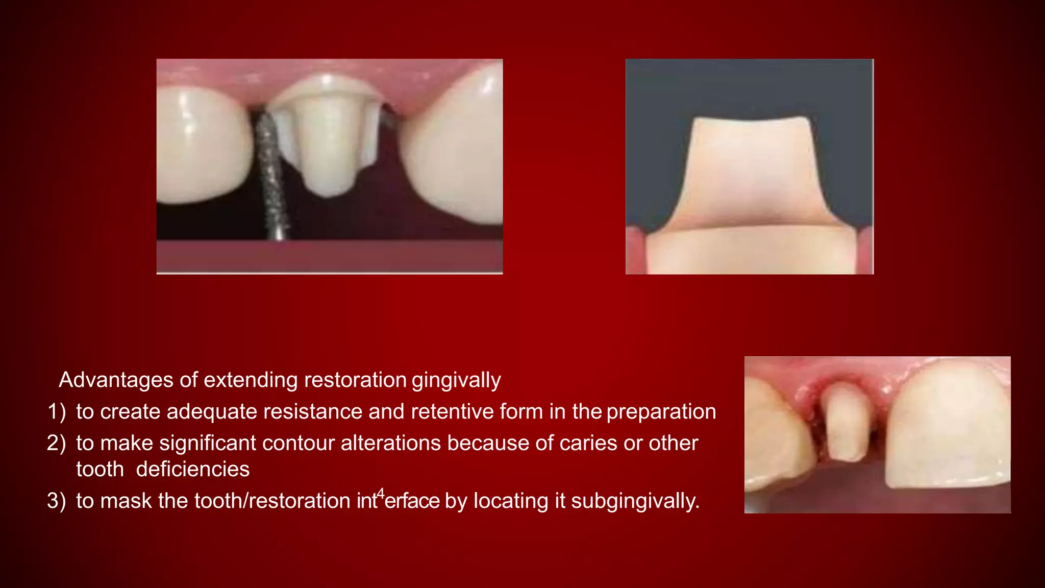 Advantages of extending restoration gingivally
1) to create adequate resistance and retentive form in the preparation
2) to make significant contour alterations because of caries or other
tooth deficiencies
3) to mask the tooth/restoration int4
erface by locating it subgingivally.
 