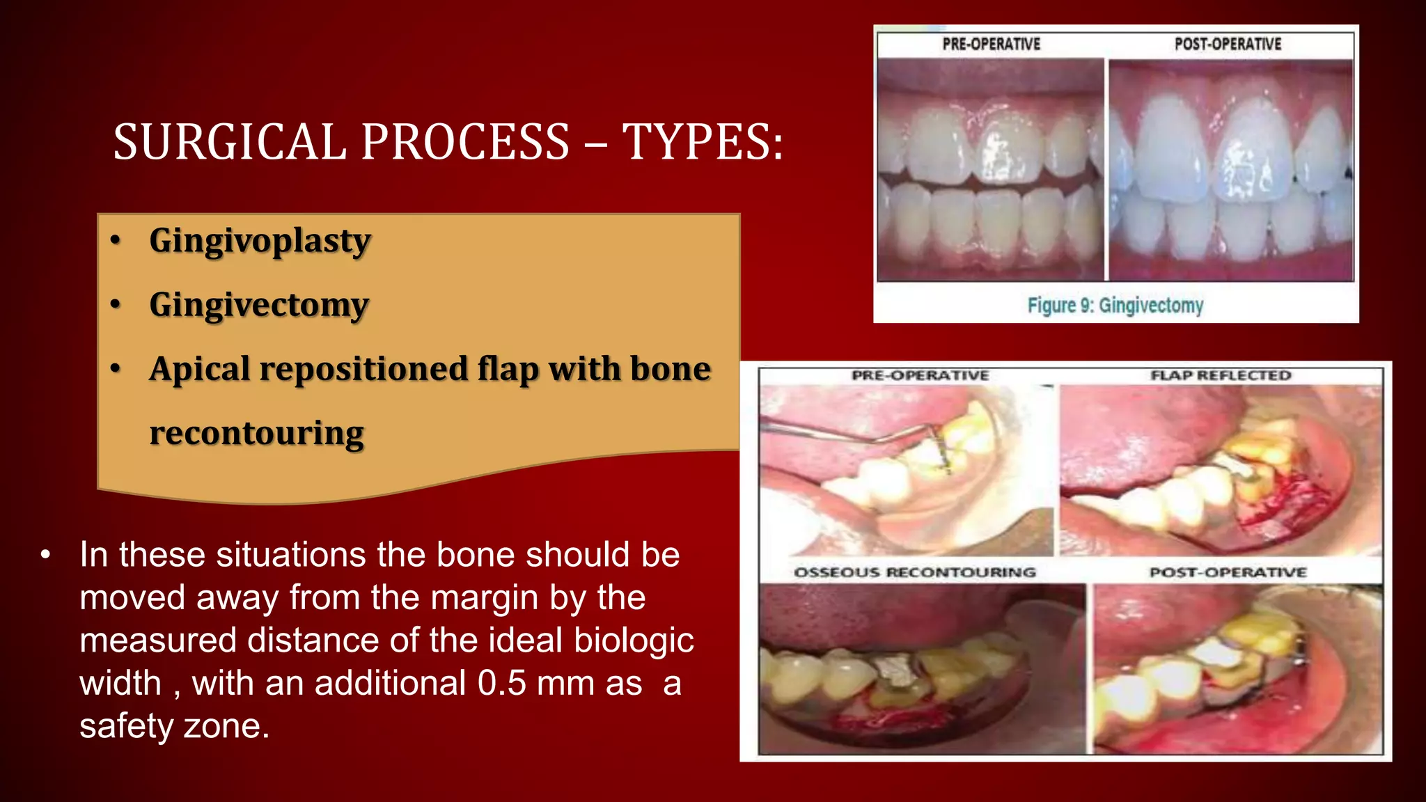 SURGICAL PROCESS – TYPES:
• Gingivoplasty
• Gingivectomy
• Apical repositioned flap with bone
recontouring
• In these situations the bone should be
moved away from the margin by the
measured distance of the ideal biologic
width , with an additional 0.5 mm as a
safety zone.
 