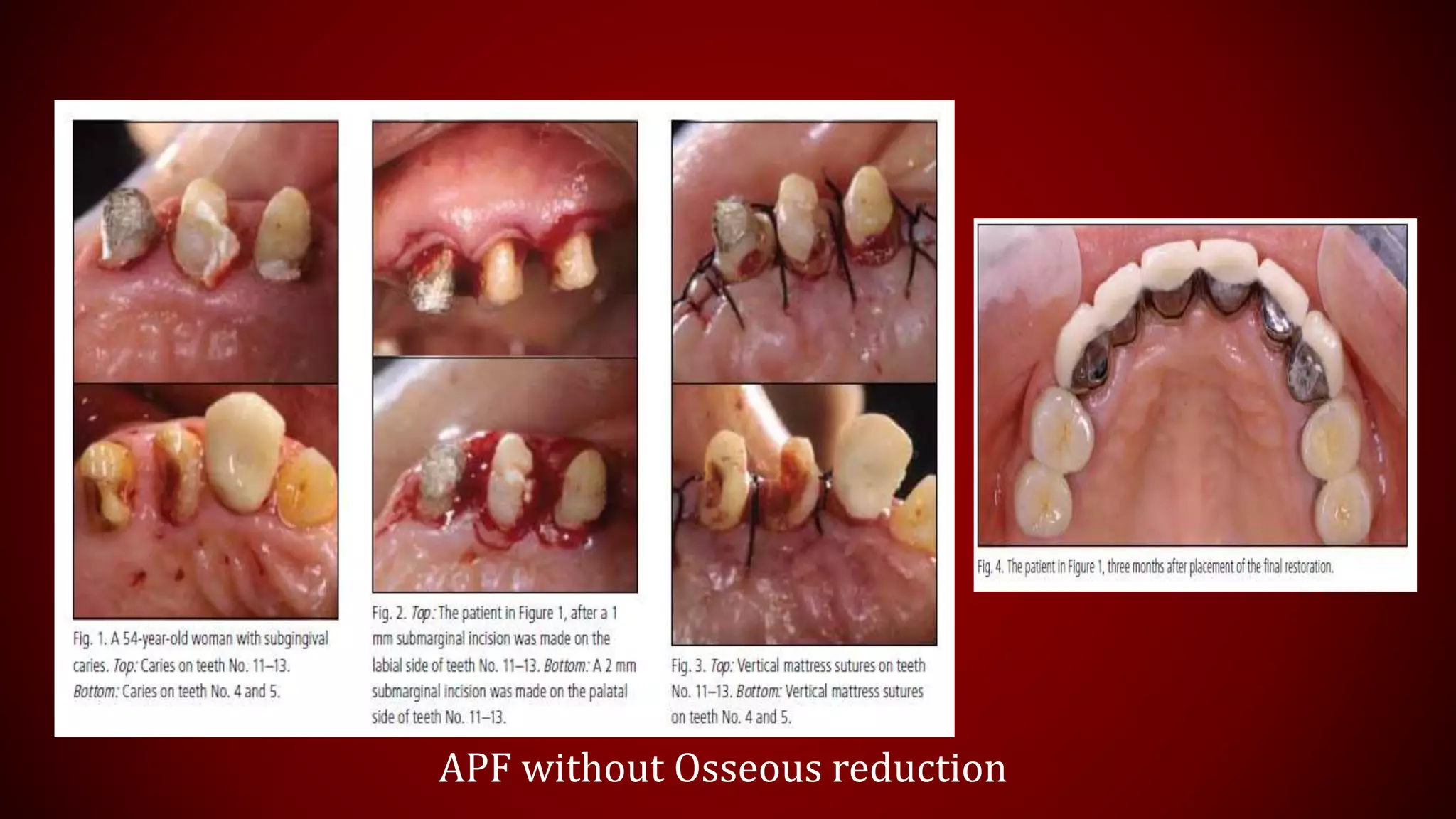 APF without Osseous reduction
 