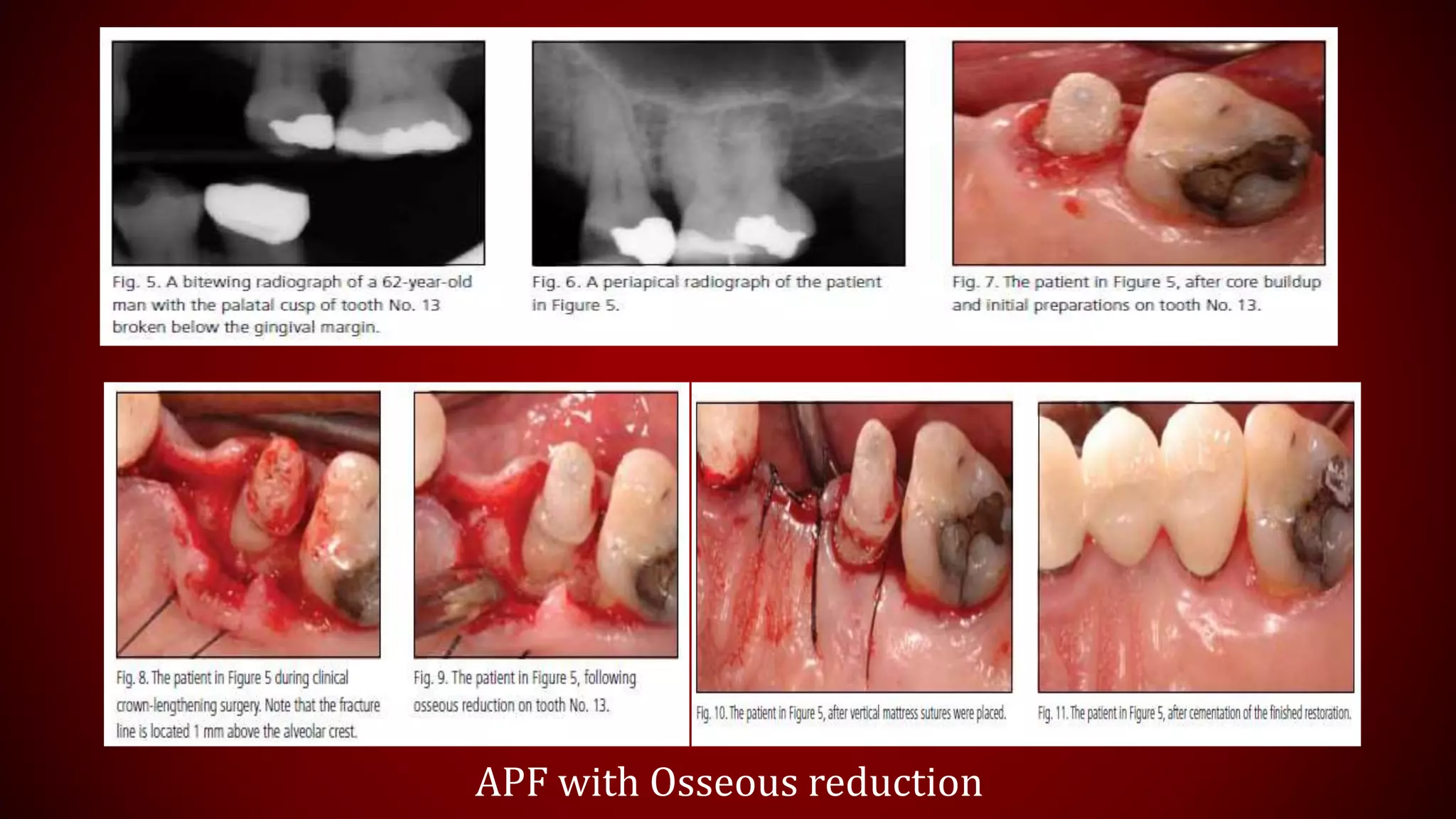 APF with Osseous reduction
 